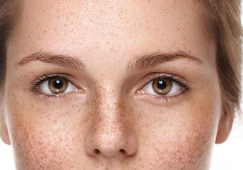 长斑了怎么办 祛斑需要内外兼治