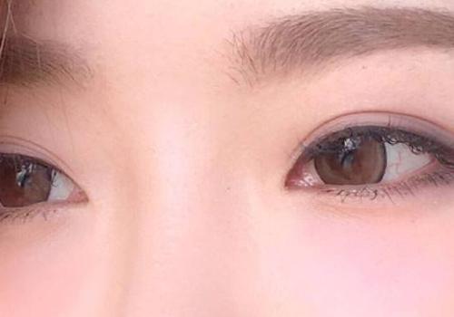 双眼皮手术有几种