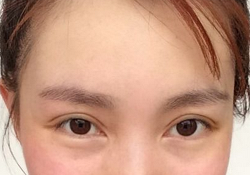 韩式双眼皮效果好吗 韩式双眼皮效果如何