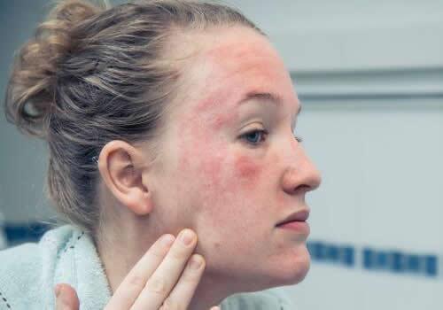 敏感性皮肤怎么修复