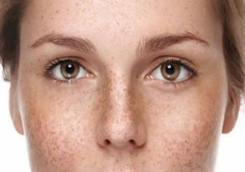 夏天适合做激光祛斑吗 什么季节最适合做激光祛斑