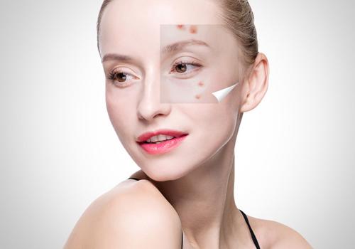 天气热长痘痘怎么回事 天气热长痘痘怎么办