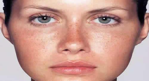 晒斑是黄褐斑吗