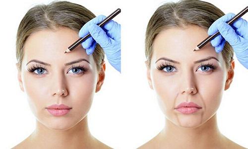 自体脂肪填充法令纹安全吗