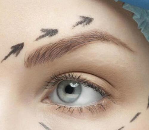 吸脂去眼袋好不好 眼袋吸脂填充效果好吗