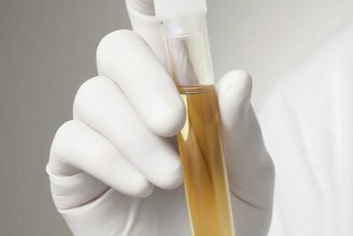 尿蛋白高会得尿毒症吗(蛋白尿严重会尿毒症吗)