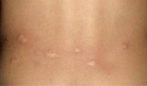 丘疹性荨麻疹的病因（丘疹性荨麻疹 病因）