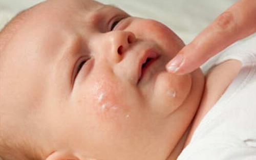 奶癣用奶水可以去除吗 奶水癣怎么办