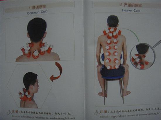 中医拔罐穴位图 中医拔罐疗法图