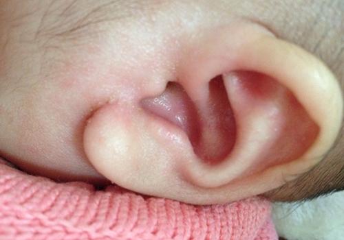 痛风耳朵会红肿怎么办（痛风引起耳朵疼）