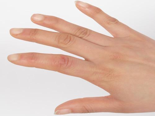 手上冻疮怎么治疗最好（手上冻疮怎么治疗最有效）