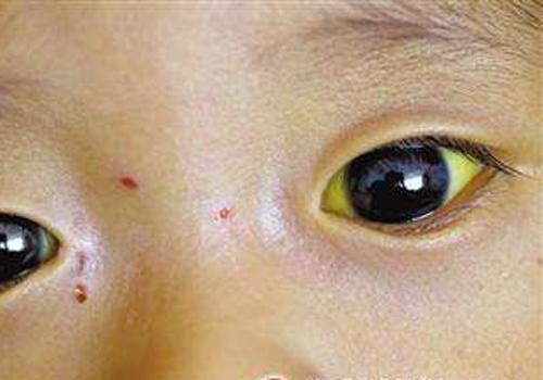 眼白发黄是怎么回事怎样快速变白（眼白发黄是怎么办）