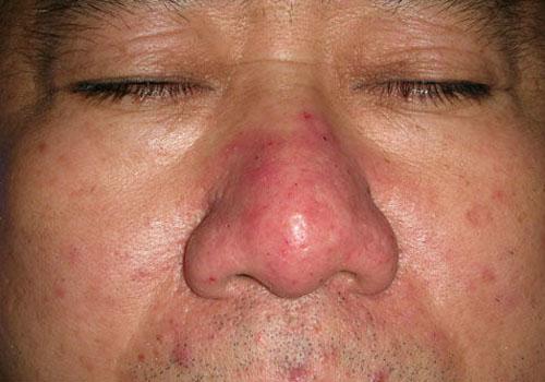 酒糟鼻可以用洁尔阴吗 酒糟鼻可以用洗面奶洗吗