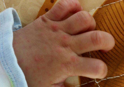 手足口病身上会起红点吗 手足口病好了手上还有些红点