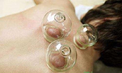 头痛拔罐拔哪里 头顶疼拔罐拔哪里