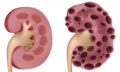 肾囊肿有哪些症状 肾囊肿有哪些症状和表现
