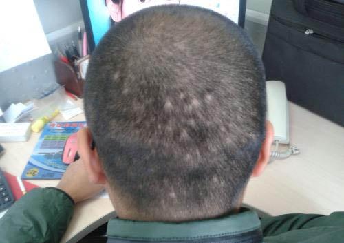 斑秃是怎么形成的（斑秃是怎么形成的有什么好的治疗方法）