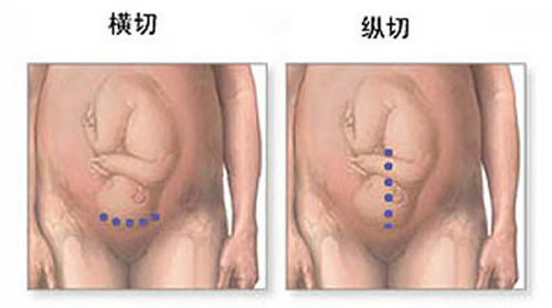 剖腹产横切还是竖切好（剖腹产横切还是竖切好恢复身材）