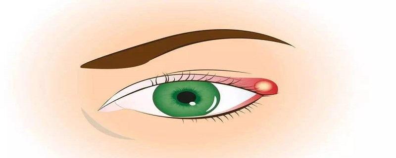 麦粒肿跟上火有关吗 麦粒肿是上火的原因吗