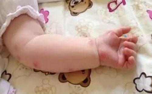 荨麻疹有什么危害(胆碱能性荨麻疹有什么危害)