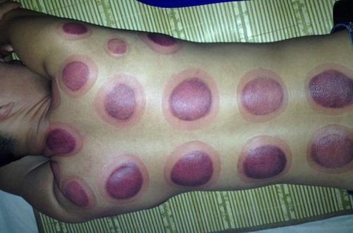 拔罐皮肤黑紫怎么回事 拔完罐皮肤黑紫