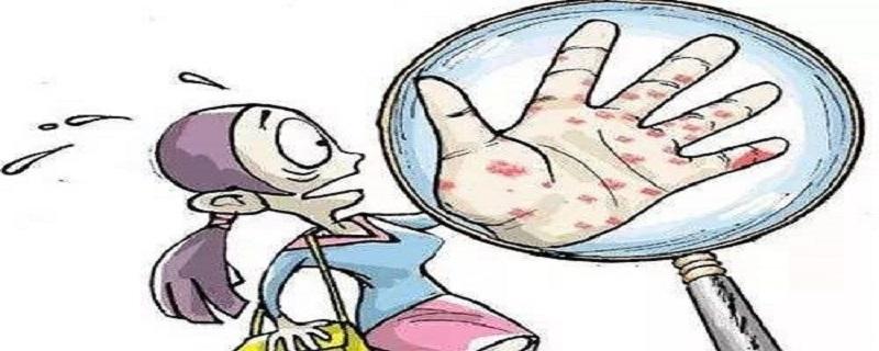 带状疱疹艾灸哪些部位 带状疱疹艾灸哪些部位图