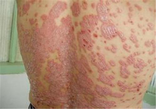银屑病会遗传给下一代吗(银屑病会遗传几代人)