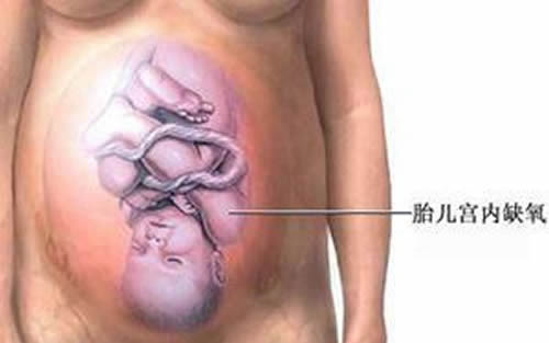 胎儿缺氧是什么原因（胎儿缺氧是什么原因造成的）