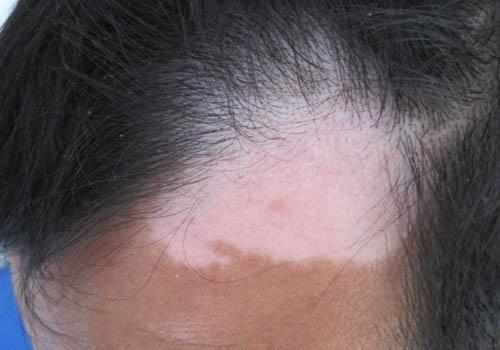 怎样补黑色素治白癜风()