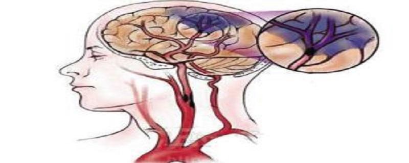 脑梗死是什么病（脑梗死是什么病严重吗）