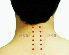 颈椎病针灸穴位图（颈椎病针灸部位图解）