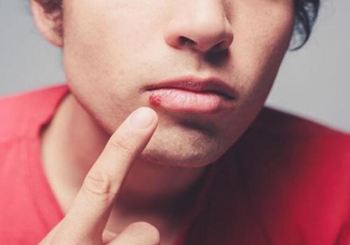 口角炎快速治愈的方法 快速治疗口角炎