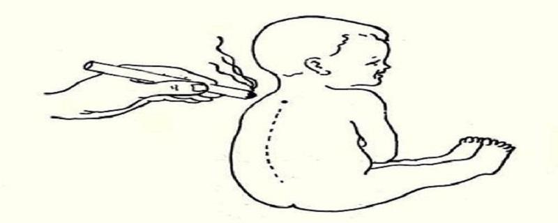 百日咳艾灸行吗（咳嗽可以天天艾灸吗）