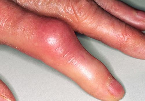 痛风吃什么药效果最好（痛风发作吃什么药管用）