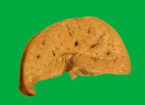 脂肪肝吃什么食物好（重度脂肪肝吃什么食物好）