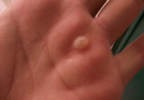 鱼痣会传染给别人吗（长痣会传染给别人吗）