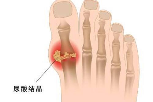 尿酸不高会不会得痛风 尿酸不高也会是痛风吗