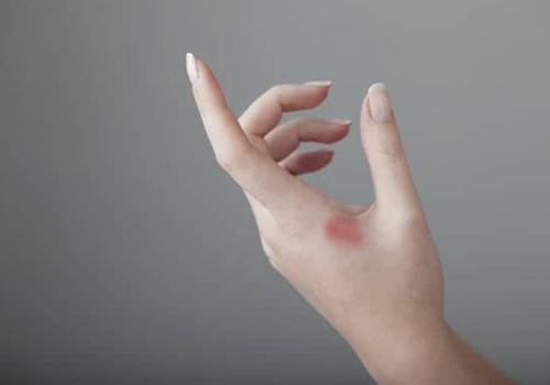 烫伤后怎么处理 一分钟教你快速急救