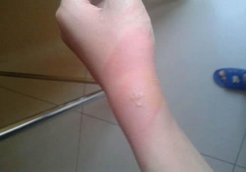 暖宝宝轻微烫伤怎么办（用暖宝宝烫伤了怎么办）