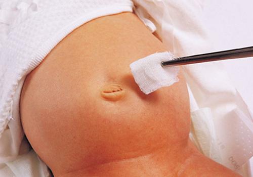 宝宝脐带消毒用酒精还是碘伏（宝宝脐带消毒是用碘伏还是酒精）