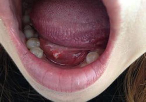舌头溃疡是什么原因造成的（烂舌头是什么原因引起的）