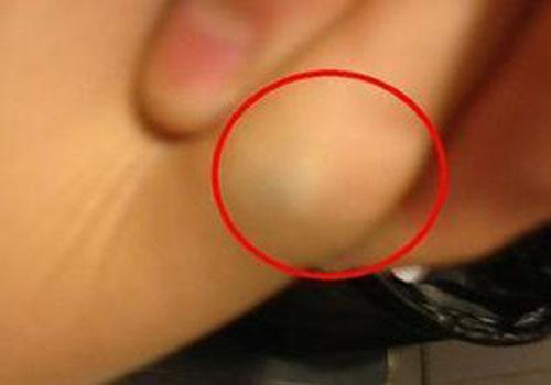 脂肪瘤传染吗(脂肪瘤传染吗为什么以前一个现在两个)