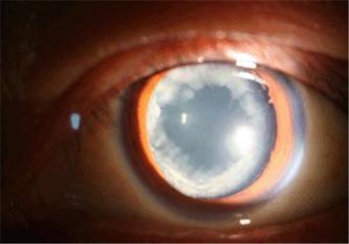 白内障的分类 白内障的分类及分期