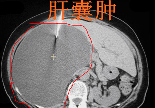 肝囊肿是怎么回事 肝囊肿是怎么回事,应该怎么处理