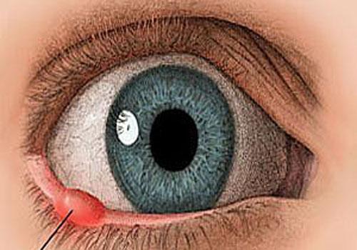 结膜炎和麦粒肿的区别(结膜炎跟麦粒肿的区别)