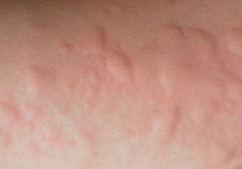 荨麻疹会不会传染 荨麻疹会不会传染给下一代