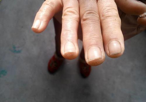 灰指甲擦醋有效果吗（醋对灰指甲有没有作用）