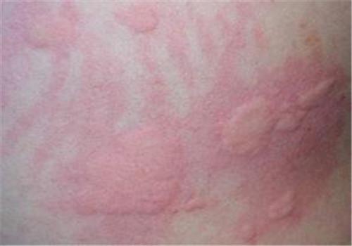 荨麻疹分为几种类型 荨麻疹分为哪几种类型