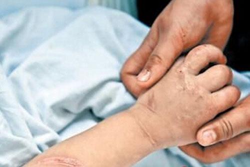 烫伤怎么才能不留疤痕 烫伤怎么才能不留疤痕吗