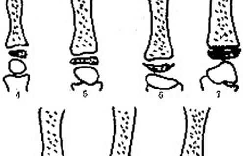 儿童骨龄检测怎么做(孩子测骨龄)